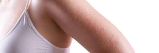KP Chicken Skin: Crossing the Road to Skin Correction
