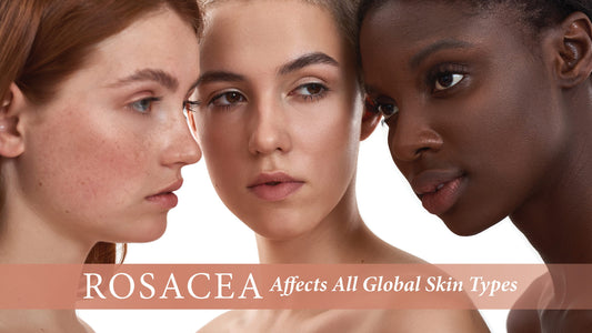 Rosacea Affects All Global Skin Types