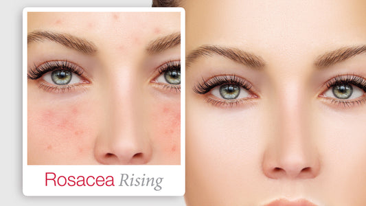 Rosacea Rising