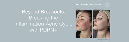 Beyond Breakouts: Breaking the Inflammation-Acne Cycle with PDRN+